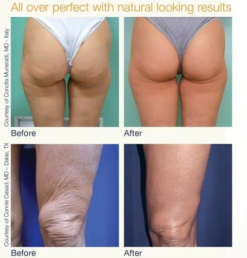 Lumenis NuEra Tight